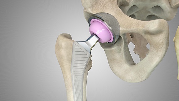 mindray-orthopaedics distributor-arthroplasty-pc